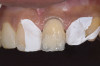 Figure 12  Layering dentin shade on tooth No. 9.