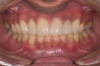 Figure 15  Maximum intercuspation (MIP) after restoration of the lost palatal anatomy.