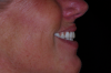 Fig 9. Flangeless denture tried-in showing importance of lip support in this case; facial view (Fig 8) and profile view (Fig 9).