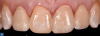 Fig 4. Provisionals were created using a bis-acryl provisional material. White resin stain used specifically for composite materials was added to the provisionals to match staining on the canines. Because this photograph was taken near the end of the procedure when the teeth had been desiccated, the staining is more prominent than usual.