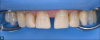 Fig 5. The gold standard for isolation during adhesive procedures is a dental dam. A split dam technique, such as the one shown in this photograph, was used for delivery of the restorations for this patient.