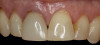 4. Facial and occlusal views of initial clinical presentation of tooth No. 8.