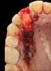 10. Tooth No. 8 with diagnosis of Grade III socket, requiring extraction followed by guided bone regeneration and a rotated pedicle flap to gain hard and soft tissue for future implant placement.