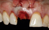 11. Tooth No. 8 with diagnosis of Grade III socket, requiring extraction followed by guided bone regeneration and a rotated pedicle flap to gain hard and soft tissue for future implant placement.