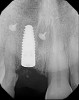 (21.) Postoperative periapical radiograph taken immediately after placement of the implant at site No. 8 demonstrating implant positioning centered with the planned location of the gingival zenith and two titanium alloy tacks that were used to stabilize the resorbable membrane apically.
