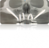 (1.) Radiograph of zygomatic implants added to a group of anterior conventional implants.