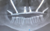 (3.) Radiograph of the pterygoid fixated arch stabilization technique, which includes two pterygoid, two zygomatic, and two conventional implants.