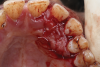 Fig 6. Clinical application of i-PRF: palatal bandage with i-PRF and A-PRF.