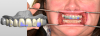 Fig 8. The intraoral scan is aligned to a digital portrait image to guide digital design.