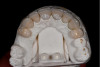 Fig 11. Layered lithium disilicate restorations on a 3D printed resin model.