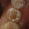 Fig 1. Preoperative view of a tetracycline-stained lower right second bicuspid.