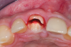 Fig 6. Initial preparation of the buccal aspect of the root to be retained.