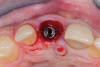 Fig 7. Finalized preparation utilizing the PET protocol, with implant placement in the No. 8 (1:1) position. An “S”-shaped chamfer preparation was made internally to the retained buccal portion of the root.
