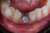 Fig 13. Anatomically correct composite-customized healing abutment immediately affixed to implant at implant placement to provide long-term physical support for the mucosal tissues.