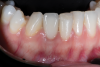 Fig 14. Final restoration on implant placed into position No. 27 (4:3) with PET protocol, illustrating the final esthetic outcome of this implant and associated restoration in a thin phenotype.