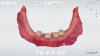 (2.) Scan bodies were placed onto each abutment, and a digital impression was made using an intraoral scanner