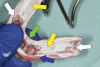 (7.) Areas of excessive pressure visualized in the disclosing material, including those from occlusal forces (white arrows), anteroposterior forces (green arrow), and oblique forces (blue arrow) as well as areas of noncontact (yellow arrows).