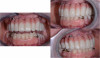 Fig 13. Final zirconia prosthesis, intraoral view.