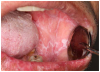 Figure 1a. Lichenoid inflammation
