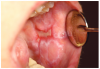 Figure 1c. Lichenoid ulceration and erythema