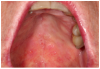 Figure 1d. Oral mucoceles