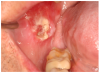 Figure 2a. Oral squamous cell carcinoma