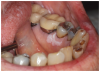 Figure 2b. Oral leukoplakia