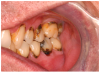 Figure 2c. Hyposalivation and dental caries