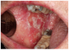 Figure 2d. Oral candidiasis