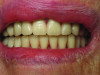 Fig 5. Set-up try-in to verify esthetics and phonetics and make adjustments as needed to tooth position.