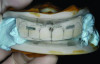 Fig 7. AvaDent’s proprietary impression system allows the dentist and patient to visualize tooth position, establish vertical, and the midline.
