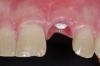 Fig 10. Emergence profile was formed for 6 weeks with the use of a temporary restoration with a screw-retained PEEK abutment.