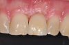 Fig 12. Metal-free, removable, screw-retained restoration. Peri-implant mucosa had no inflammation or discoloration.