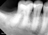 Fig 2. A 63-year-old male patient presented with a chief complaint of spontaneous pain and pressure discomfort of 3-week duration. A distal fracture line was visible on tooth No. 30, with a localized 7 mm deep periodontal probing depth adjacent to its distal aspect. The tooth had no response to pulp sensitivity testing and was sensitive to percussion. Periapical imaging (Fig 2) revealed a tooth with a shallow restoration and early signs of apical pathology. CBCT imaging (Fig 3, axial view, top left; and sagittal view, bottom right) confirmed early signs of apical pathology and showed localized crestal bone loss adjacent to the distal fracture line. A diagnosis of pulpal necrosis with symptomatic apical periodontitis was made, and the fracture was determined to involve root structure given the periodontal findings and radiographic crestal bone loss noted. The patient elected to pursue extraction with implant replacement given the reduced long-term prognosis for maintenance of the tooth.