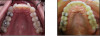 Fig 6. Left panel: Overlapping of teeth Nos. 7 and 10 before treatment. Right panel: Results after clear aligner therapy without interproximal reduction.