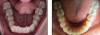 Fig 7. Left panel: Overlapping of tooth No. 27 before treatment. Right panel: Results after clear aligner therapy without interproximal reduction.