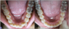 Fig 8. Left panel: Crowding in mandibular anterior region before treatment. Right panel: Results after clear aligner therapy and interproximal
reduction.