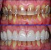 Fig 2. Zirconia crowns used to mask out tetracycline-stained teeth. Teeth Nos. 4 through 6 and 11 through 13: monolithic; teeth Nos. 7 through 10: milled full-contour (monolithic), then cut back and layered.