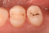 (1.) Pretreatment photograph of primary and a secondary caries on teeth Nos. 12 and 13.
