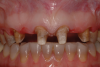 (8.) Retracted close-up view after removal of the defective fixed partial dentures.