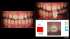 Fig 1. Left panel: Presentation of 14-year-old patient before teethbleaching
treatment. Prior to treatment, a careful shade analysis
should be done to establish a baseline reference point, utilizing
traditional shade guides and digital photography (top right panel) or
a more objective and precise colorimeter (bottom right panel).