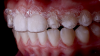 Fig 6. Clear aligners may serve a dual purpose as a
custom-fit bleaching tray. In addition, the patient benefits from the antibacterial properties and beneficial cariostatic effects of the urea byproduct
in 10% carbamide peroxide when the custom-fit tray (ie, the aligners) is allowed to remain in contact with the gingiva overnight.