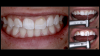 Fig 7. Initial
presentation before teeth-bleaching treatment (left panel) and pretreatment tooth shade evaluation (right panel) of a patient with stained
composite resin on gingival third of maxillary central incisors.