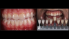 Fig 8. Following 2 weeks of at-home whitening with 10% carbamide
peroxide in custom-fit trays (Pola Night, SDI, left panel), the
patient shown in Figure 7 elected to have the bonded composite
restorations on the maxillary incisors removed (right panels). The
uniform tooth color under each restoration at the time of their
removal demonstrates the ability of the bleaching gel to permeate
the dental hard tissues.