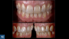 Fig 10. Discoloration of a nonvital single central incisor is a common clinical situation that can be addressed through a safe and conservative approach utilizing an internal bleaching technique (the “walking bleach” technique) with 10% carbamide peroxide (Pola Night, SDI).
