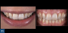 Fig 11. Left panel: The final esthetic results after 1 week of nonvital intracoronal bleaching (the “walking bleach” technique) and a 2-week color stabilization phase. Right panel: Occasionally the discolored tooth may appear slightly whiter than the adjacent teeth in retracted photos following internal bleaching; however, this situation is rarely objectionable to the patient and may prompt a request to bleach their remaining teeth.