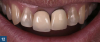Fig 12. The replacement of restorations over nonvital teeth represents a collaborative challenge for the clinical and laboratory teams.