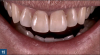 Fig 15. Final delivery of full-contour porcelain crowns on the central incisors in the patient shown in Figure 14. For restorations that will be adhesively luted over internally bleached teeth, a minimum waiting period of 2 weeks should be observed to allow the dissipation of excess oxygen that may otherwise negatively impact the bond strength of the cement.