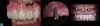 Fig 16. Implant failure is a common occurrence in clinical practice with both fixed restorations (left panel) and  removable prosthetics (middle and right panels).