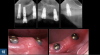 Fig 18. Top panel: Vertical bone loss around endosseous implants may result in loss of soft tissue and exposed implant threads that are challenging to keep clean because of their roughened surface. Bottom panel: Application of 10% carbamide peroxide using a custom-fit tray (Pola Night, SDI) or the patient’s existing removable prosthesis aids in the maintenance of a clean implant surface through the reduction of bioburden and build-up around the exposed titanium threads.v